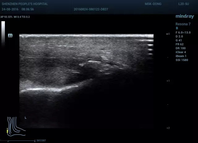 跟腱病变超声诊断