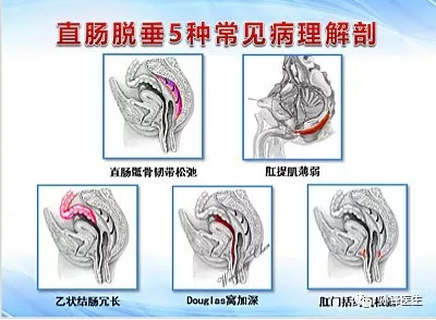 直肠脱垂的5种常见病理解剖