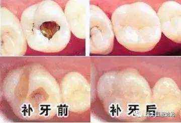 补牙和根管治疗有何不同