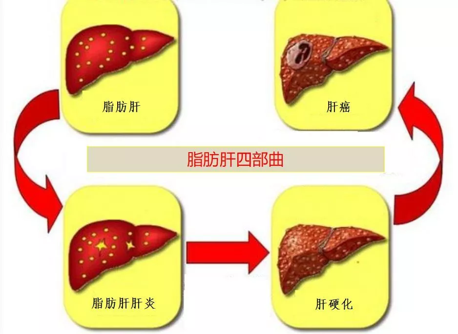 每3个人里就有1个脂肪肝患者,脂肪肝可致癌,你要小心哦!