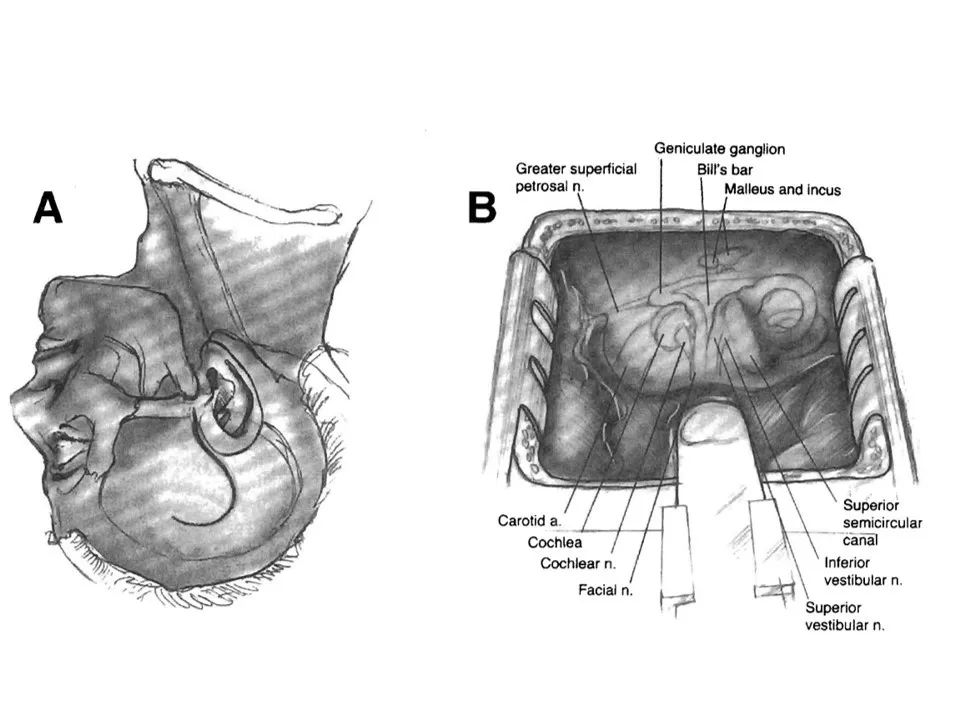 once the arcuate eminence and the greater superficial petrosal