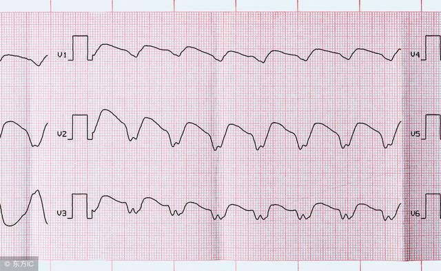 常见的室性心律失常心电图有以下三种