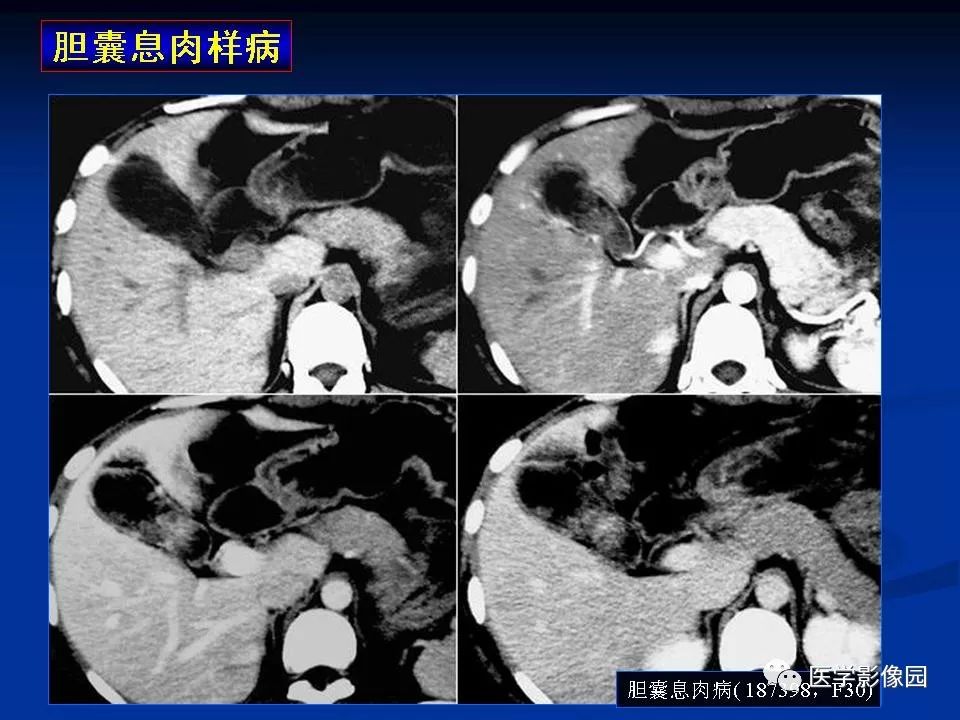 胆囊病变影像诊断与鉴别诊断(二) | 影像天地
