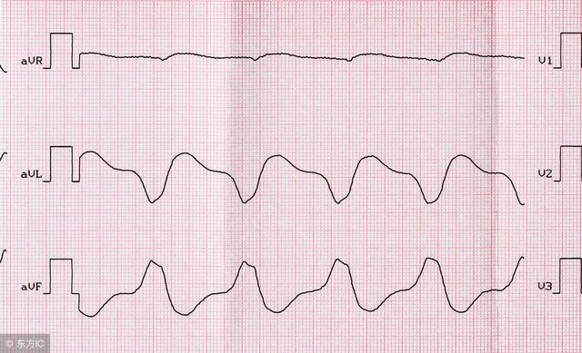 常见的室性心律失常心电图有以下三种