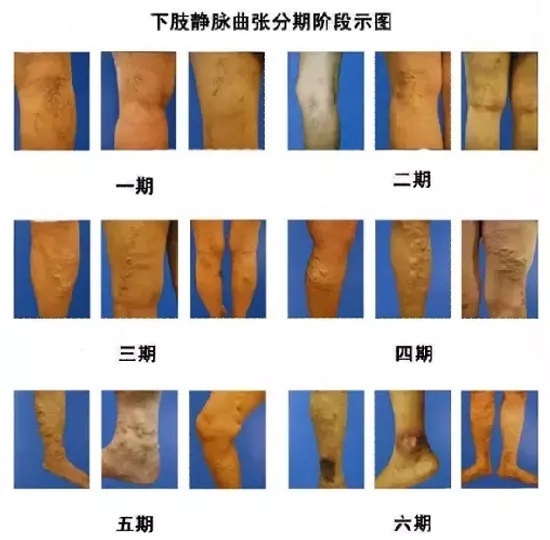 静脉曲张的预防护理太实用了记得收藏