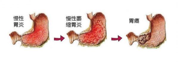 萎缩性胃炎是胃萎缩变小了