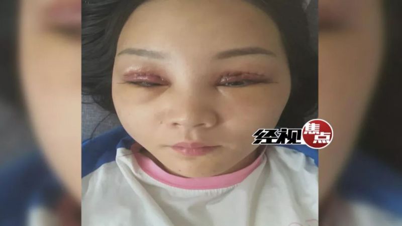 湖南女子花2万元割双眼皮术后皮肤坏死整容变毁容