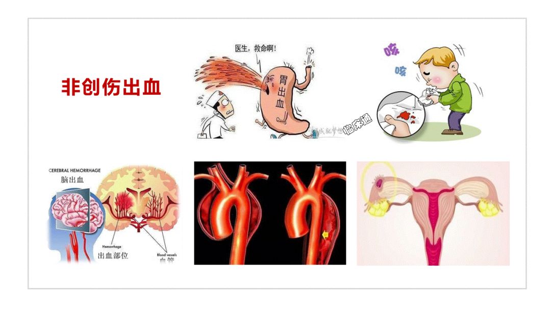 课件上架:非创伤性出血