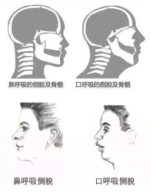 打呼的人由于上呼吸道的狭窄或阻塞, 多会从"鼻呼吸"改为"口呼吸"