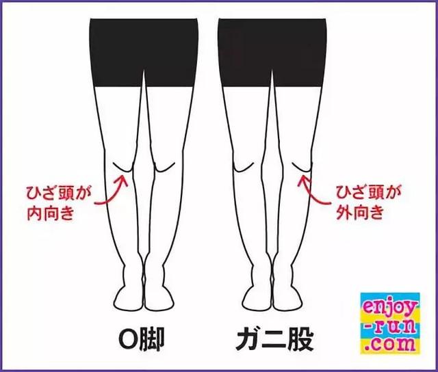 为什么日本女生罗圈腿居多呢 膝盖