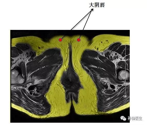 医学笔记锋哥教你读盆腔核磁共振1女性经大阴唇和阴蒂的横断层