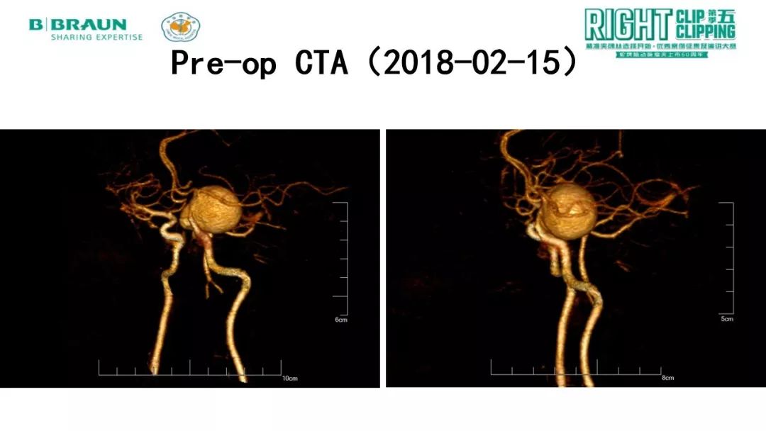 静脉-大脑中动脉高流量搭桥辅助右侧颈内动脉床突段假性动脉瘤孤立术