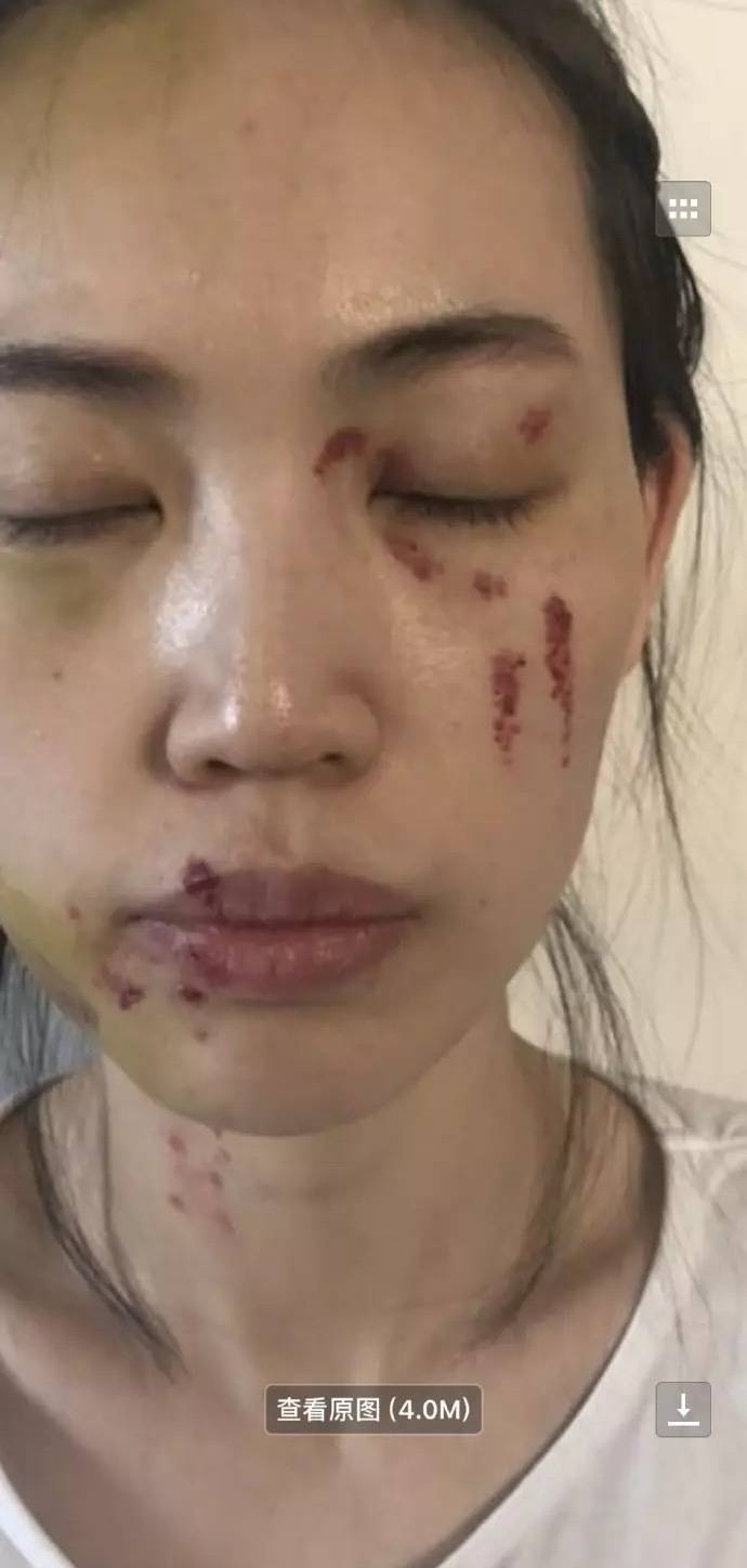 关于马蓉伤势的照片流出,据她某亲属的说法,马蓉被打的很惨,几乎毁容