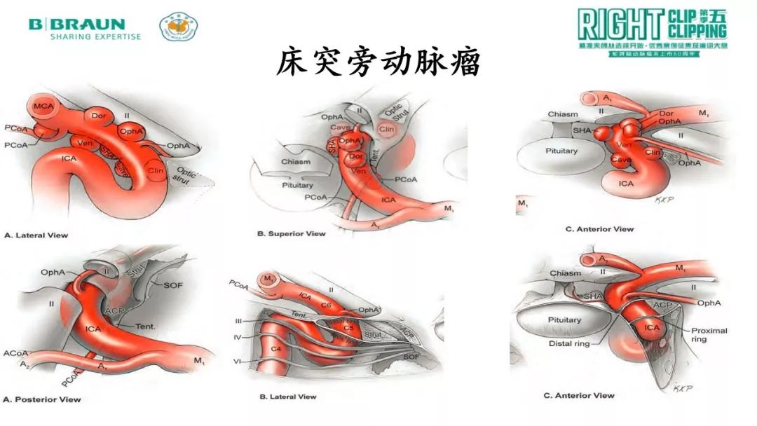 rcrc第五季精彩荟萃丨床突旁巨大动脉瘤手术治疗,颈外