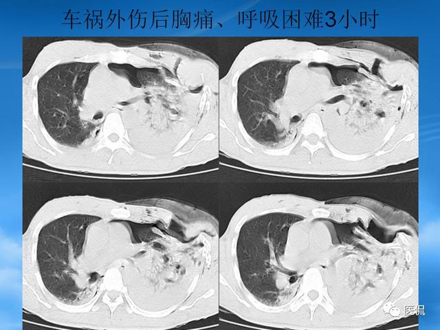 肺挫伤的影像诊断医学影像经典ppt