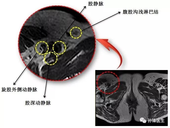 医学笔记|锋哥教你读盆腔核磁共振(1):女性经大阴唇和