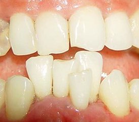 导致牙齿错位的因素有哪些