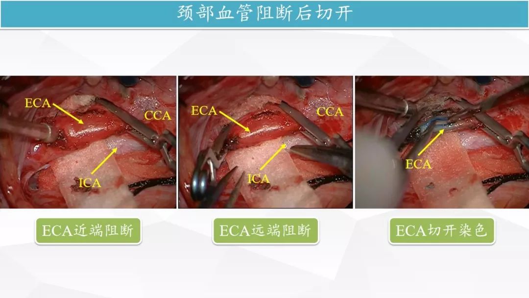 rcrc第五季精彩荟萃丨床突旁巨大动脉瘤手术治疗颈外动脉大隐静脉大脑