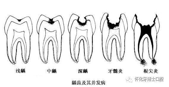 容易掉; 3,蛀牙引起根尖炎,牙龈上长脓包,这种情况医生会拍片检查症状