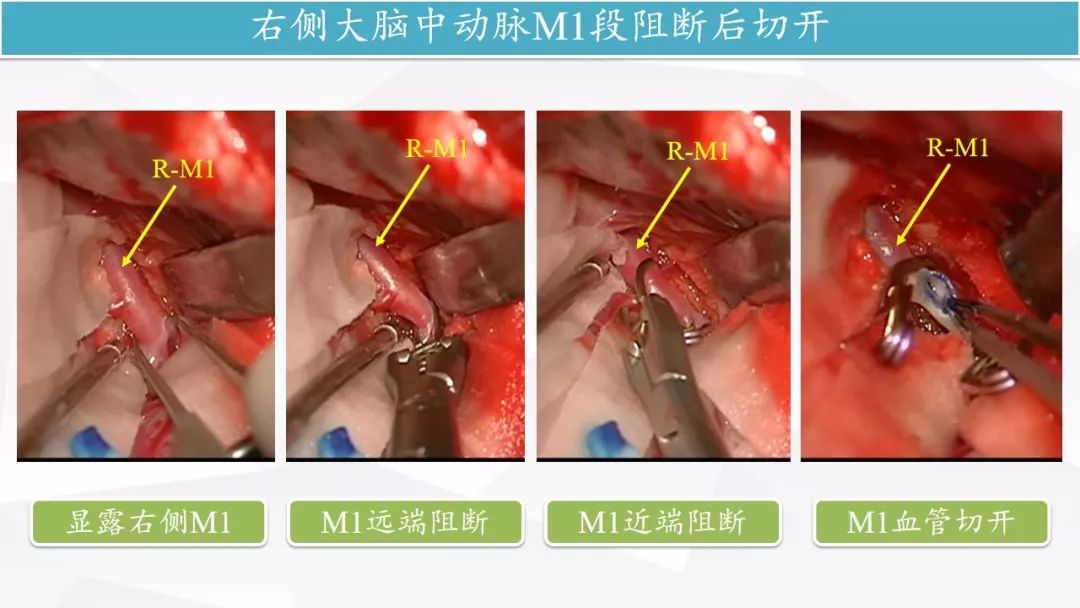 荟萃丨复合手术室血管内逆行抽吸减压辅助的巨大床突旁动脉瘤夹闭术