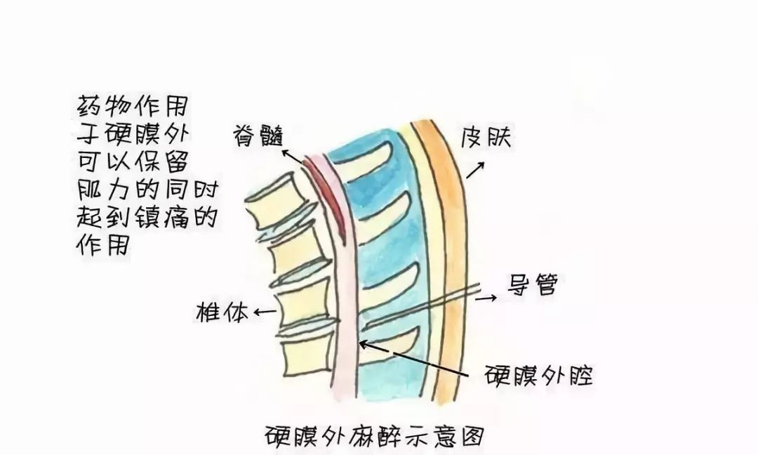 " "下辈子再也不当女人了" …… 硬膜外镇痛被认为是最有效的分娩镇痛