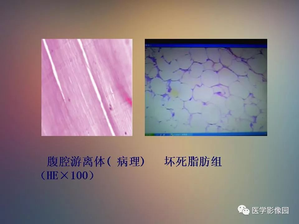 腹腔游离体的诊断病例 影像天地