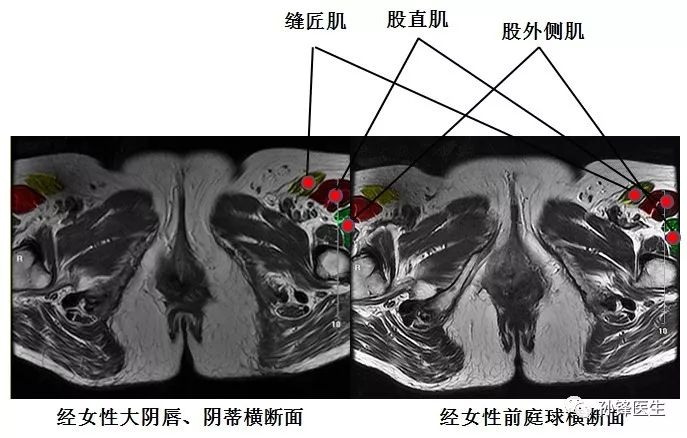 医学笔记|锋哥教你读盆腔核磁共振(2:女性经前庭球的横断面