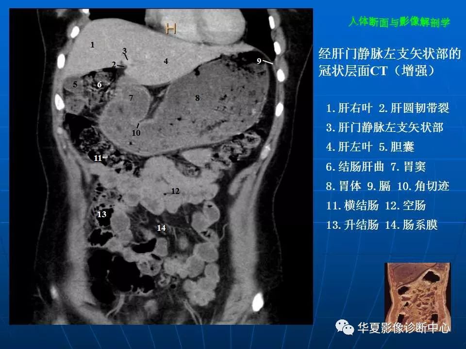 腹部断层影像解剖续