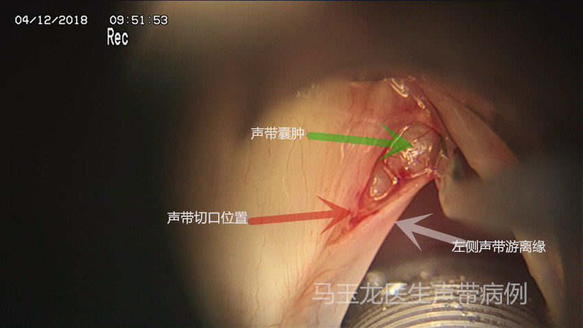 声带粘连怎么办?(声带息肉,声带囊肿避免手术后粘连技巧).