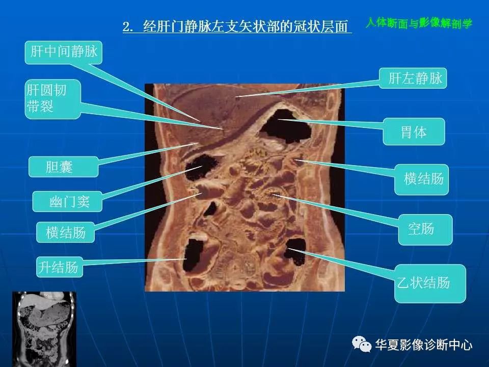 腹部断层影像解剖(续)