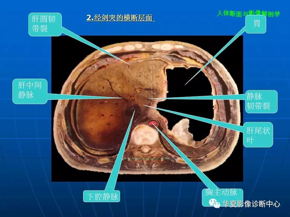 腹部断层影像解剖