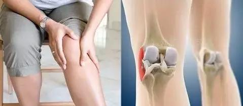 膝关节骨性关节炎