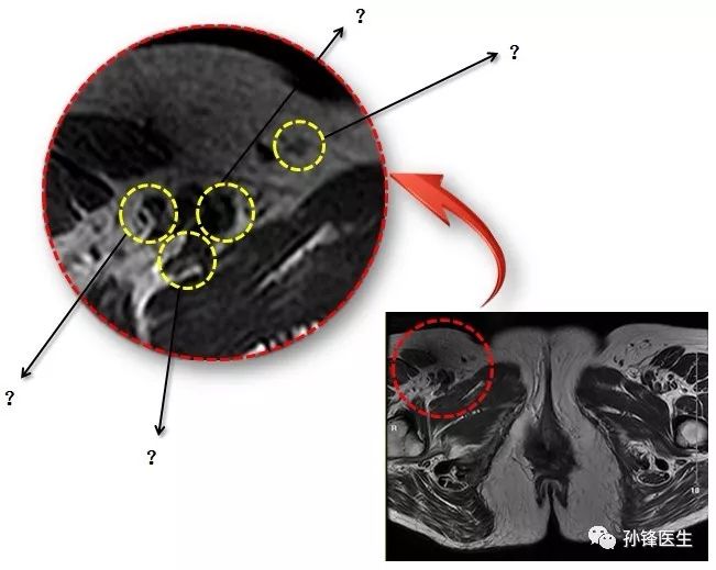 医学笔记|锋哥教你读盆腔核磁共振(2:女性经前庭球的横断面
