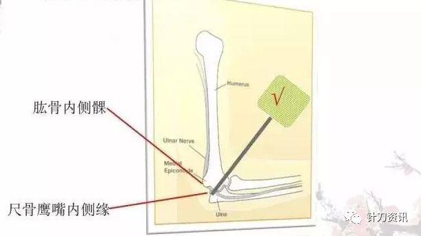 针刀疗法的原理_蓄元健康超微针刀疗法