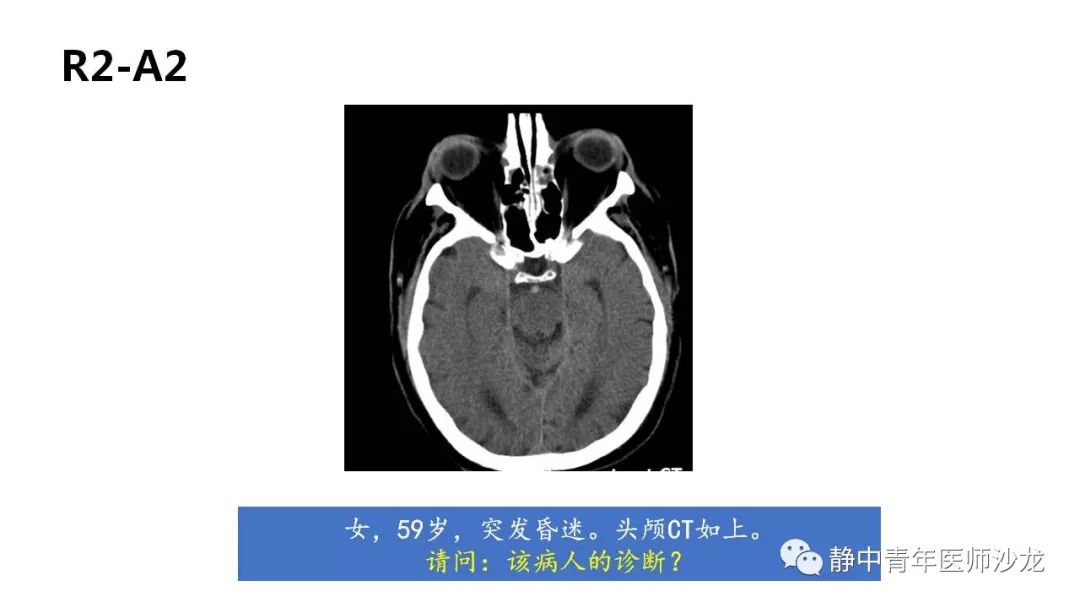 答案:frank征