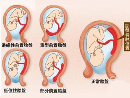 胎盘前壁后壁前置后置哪种位置安全孕妈妈了解清楚才安心