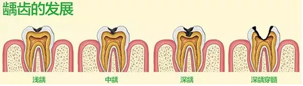 龋洞时怎么办