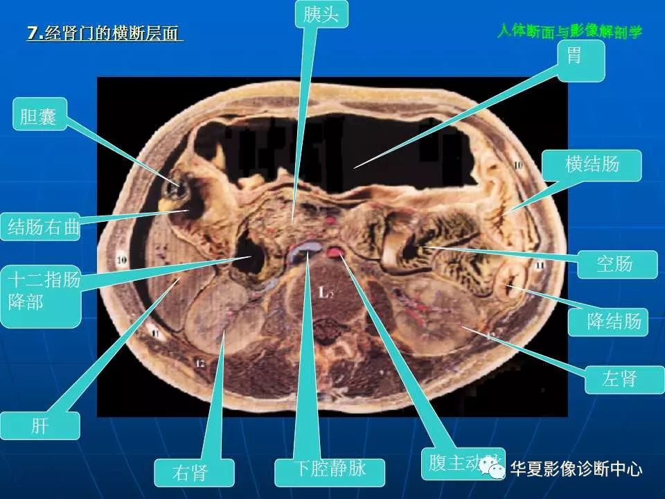 腹部断层影像解剖