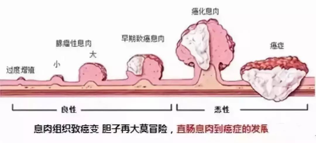 我叫"息肉",很容易变癌,但我最怕"它"!