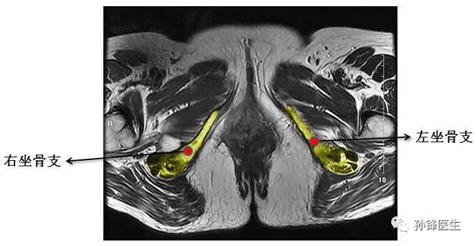 医学笔记|锋哥教你读盆腔核磁共振(2:女性经前庭球的横断面