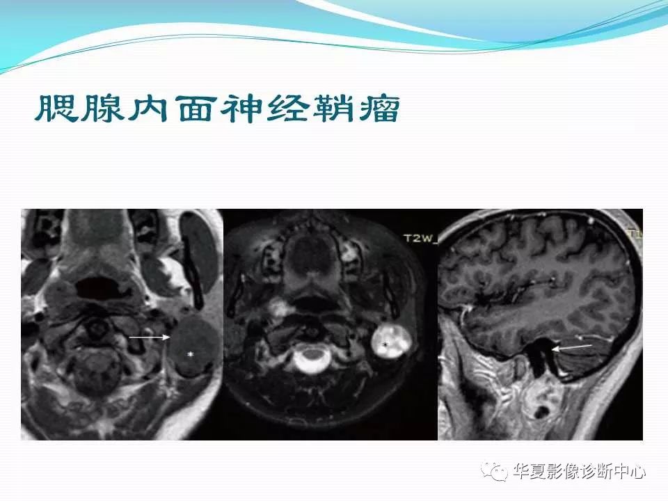 面神经解剖及常见病变影像诊断