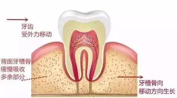 做牙套的原理_牙齿矫正的原理,原来牙套是这样移动的