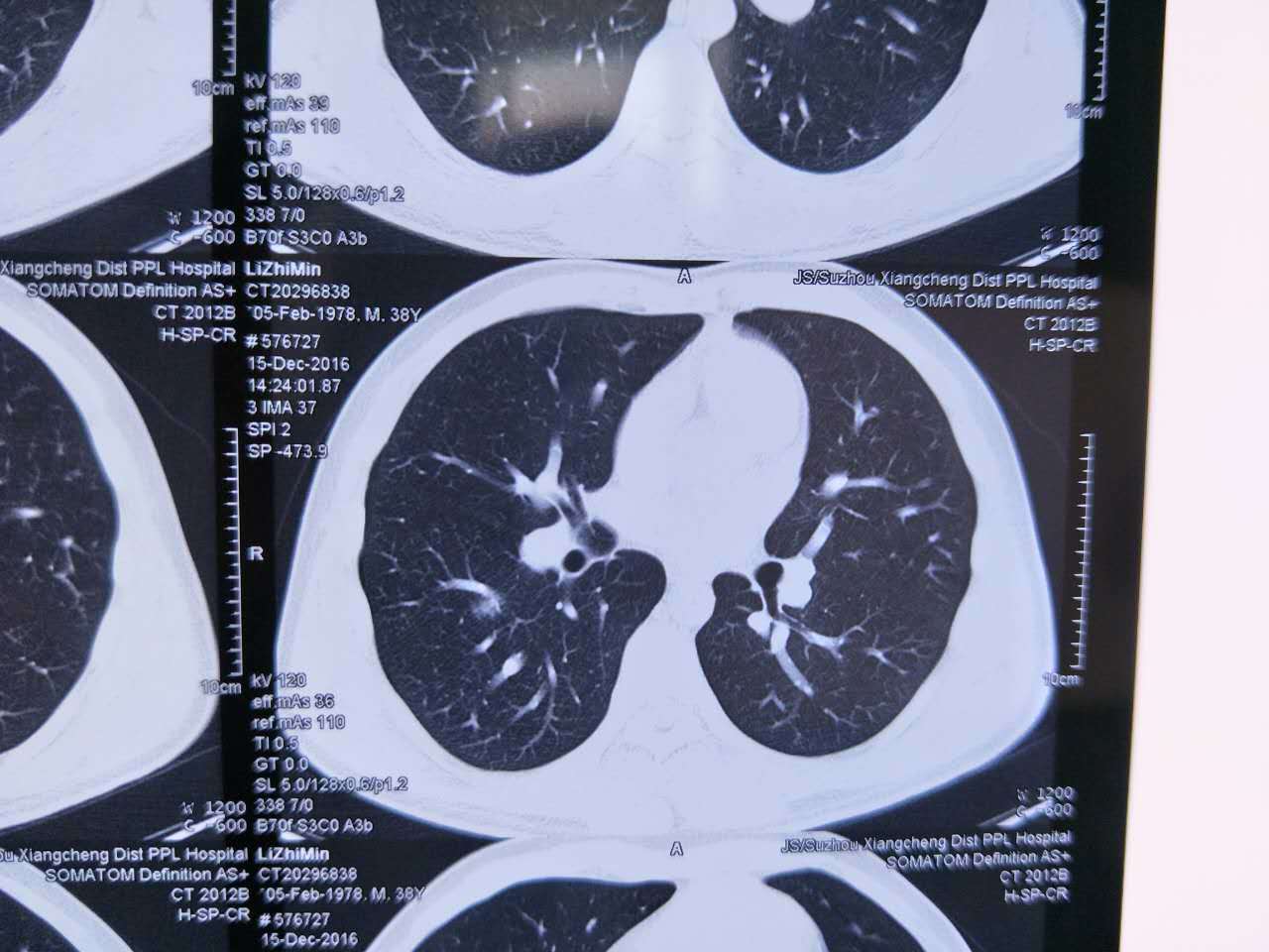 我三十二岁,查出右肺部上叶有5mm大小磨玻璃结节,可以买保险  问吧.