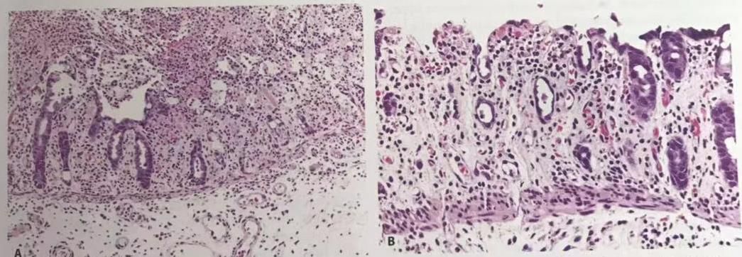 梭状芽孢杆菌感染伴纤维脓性坏死渗出物黏附于坏死表面引起伪膜