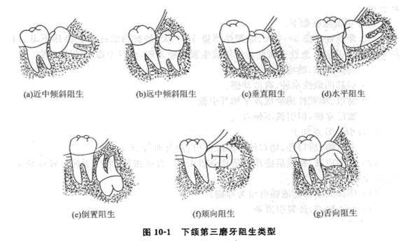 当你的智齿是近中阻生,水平阻生,垂直阻生,远中阻生等情况,就应该拔出