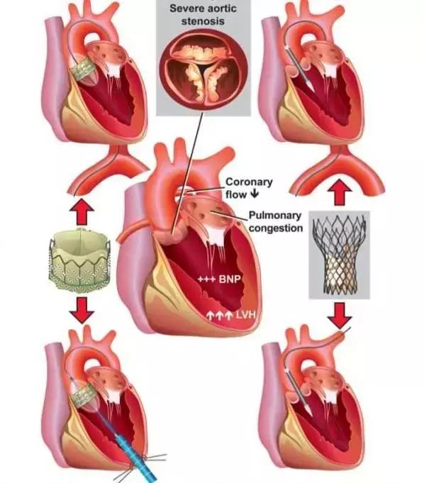 冠状动脉介入治疗在经导管主动脉瓣植入患者中的治疗时机