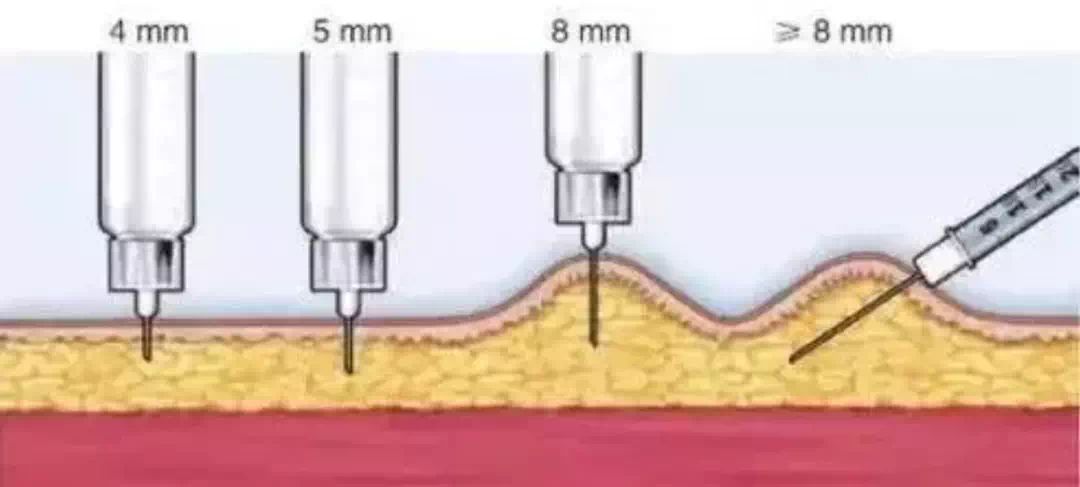 皮下注射胰岛素时,到底需不需要捏起皮肤?_针头