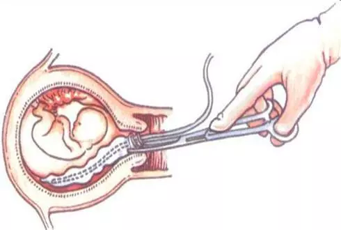 【聊城孕妇摄影】怀孕7月引产,引出胎儿还在挣扎.