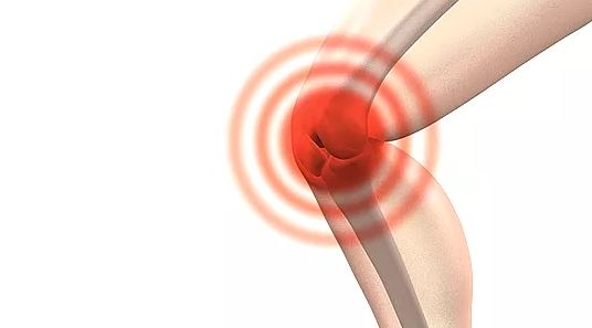 令人痛苦的膝關節炎，究竟能不能擺脫？ 健康 第1張