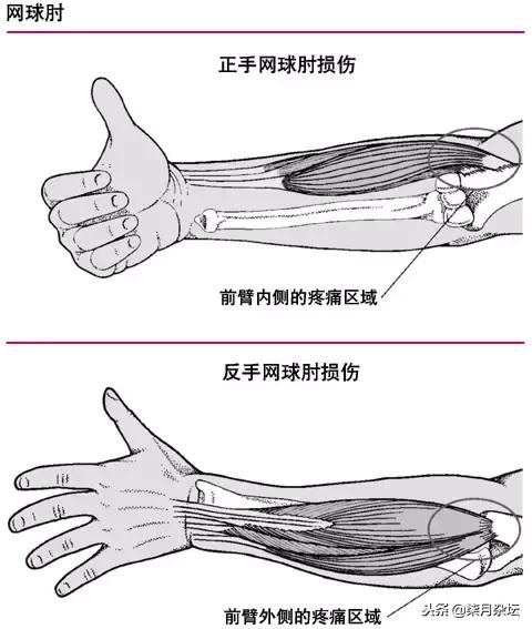 羽毛球运动损伤及网球肘康复!